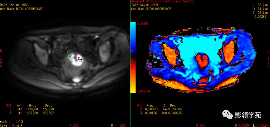 宫颈癌mri诊断,宫颈癌的mr扫描技术