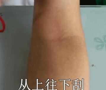 拍打肘窝出现紫痧治疗嗓子疼,小胳膊窝拍打出痧有哪些好处