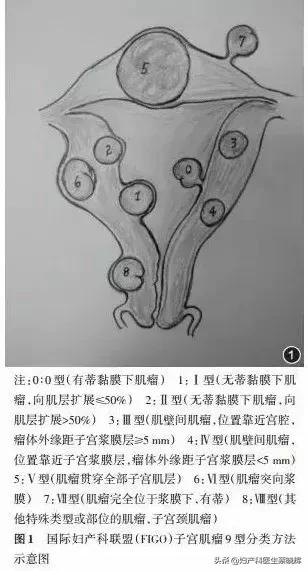 子宫肌瘤PK战之子宫肌瘤你有吗？