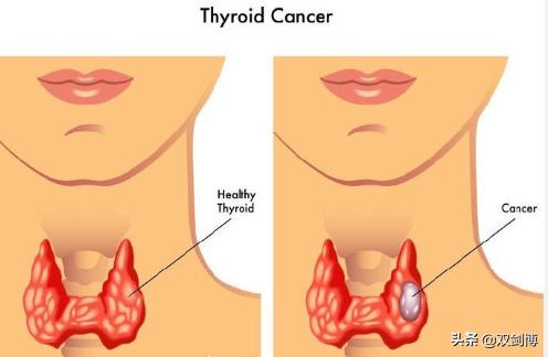 甲状腺癌手术后转移淋巴后果,甲状腺癌术后转移几率大吗