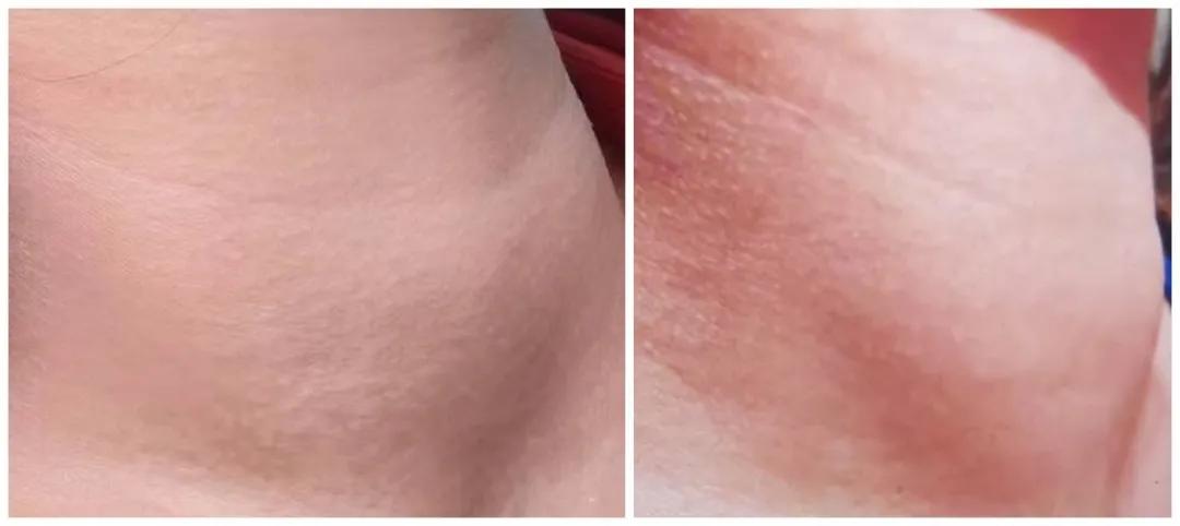 脖子肿吃药才消肿,吃了激素药会脖子发肿吗