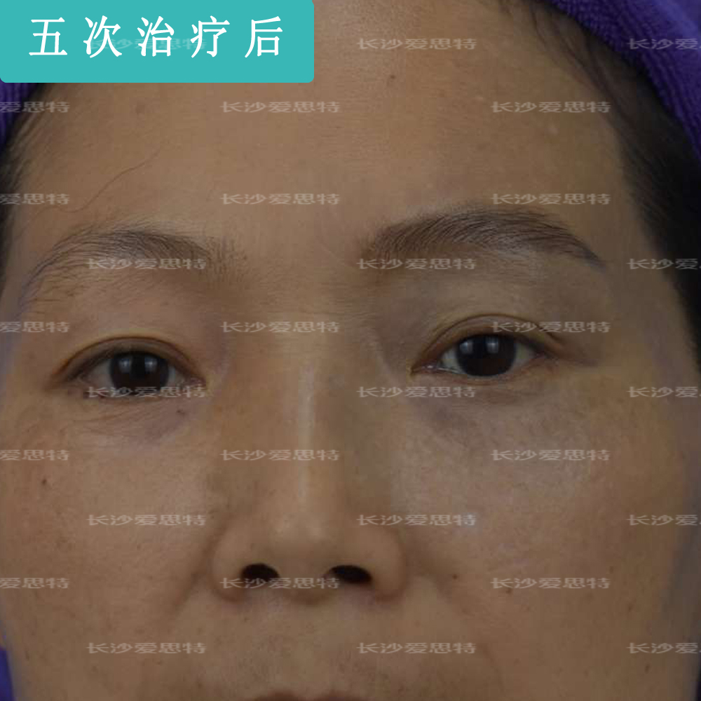 激光祛太田痣视频,疤痕太田痣皮秒激光祛斑恢复过程