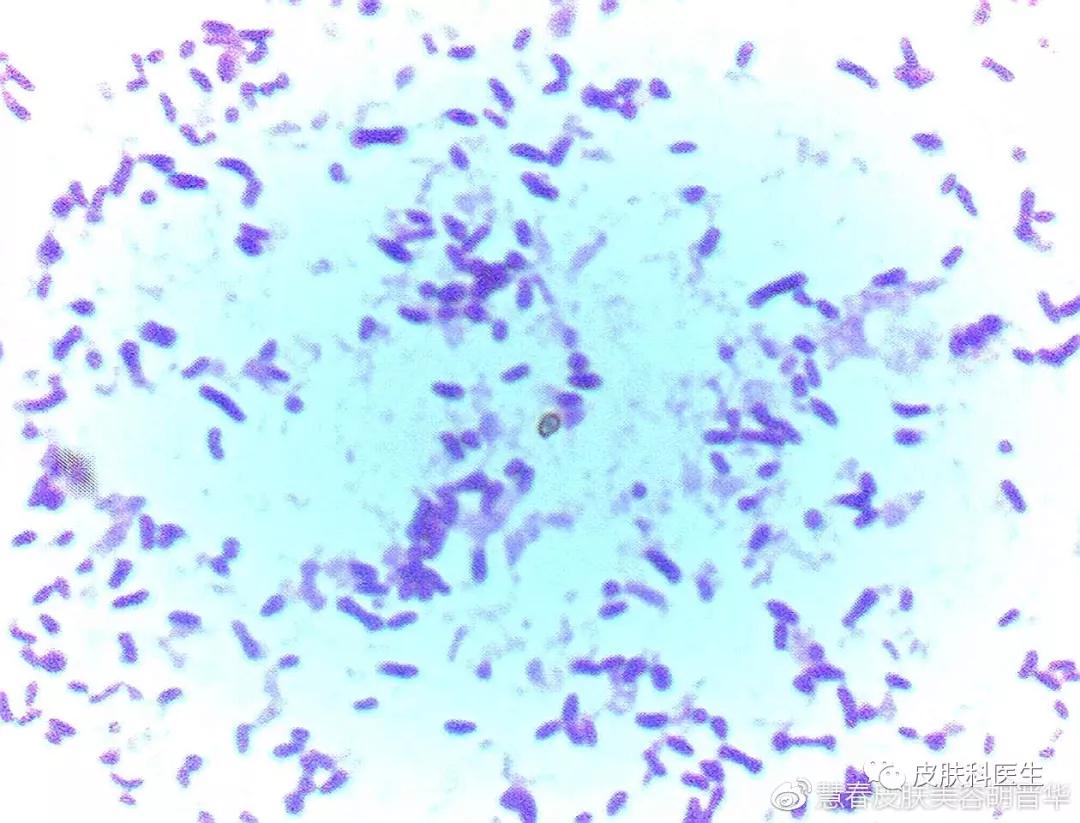 是不是皮肤癣，皮肤真菌镜检来告诉你！