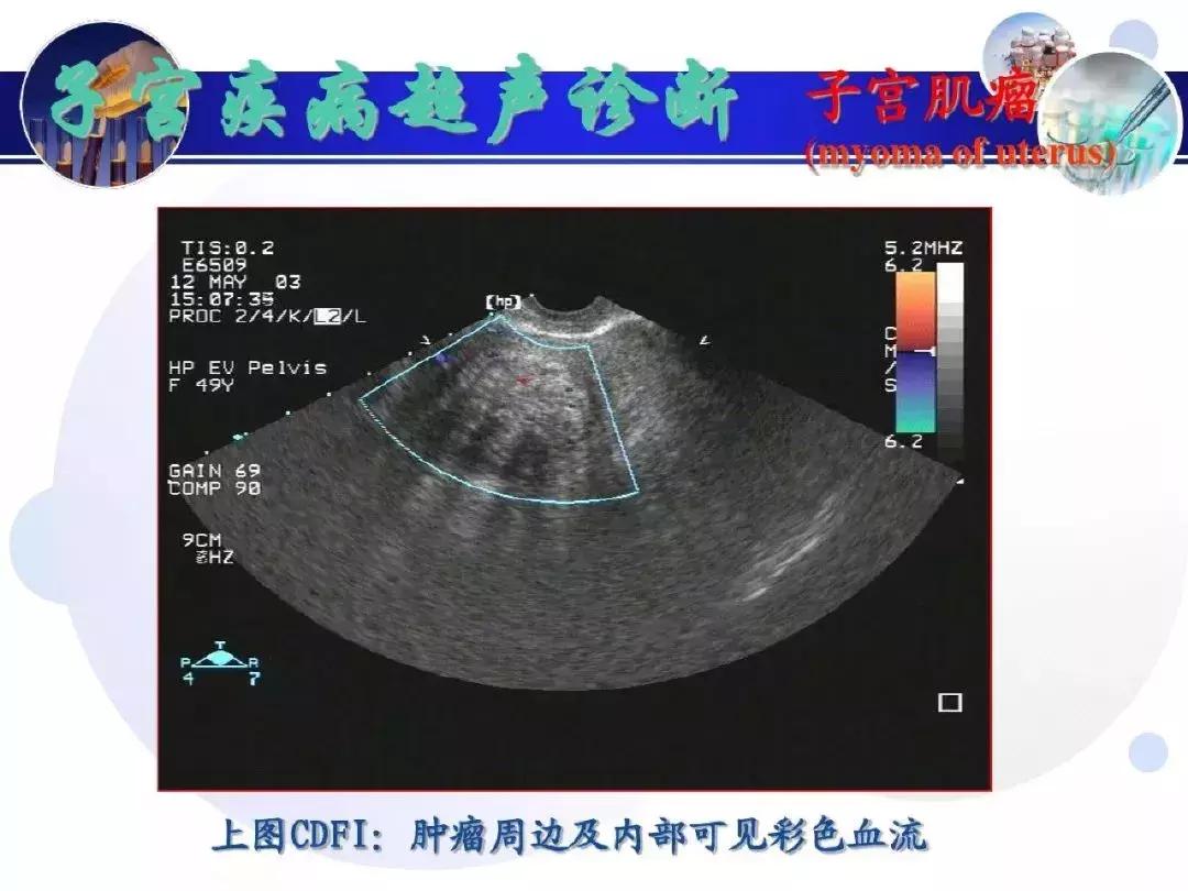 纯干货！子宫及附件解剖和超声诊断