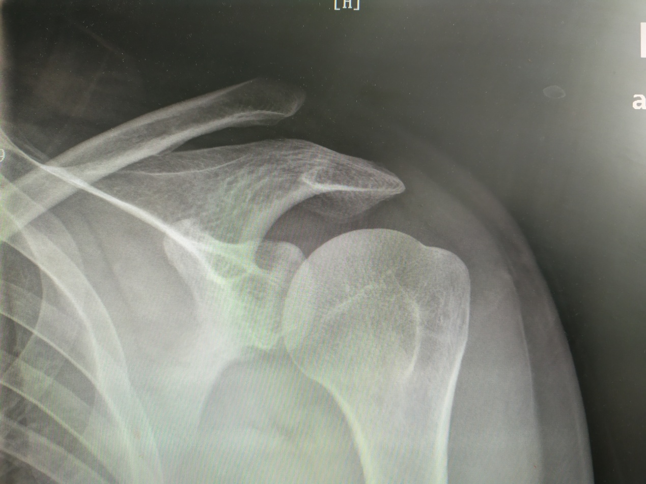 肩锁关节脱位治疗,肩锁关节脱位