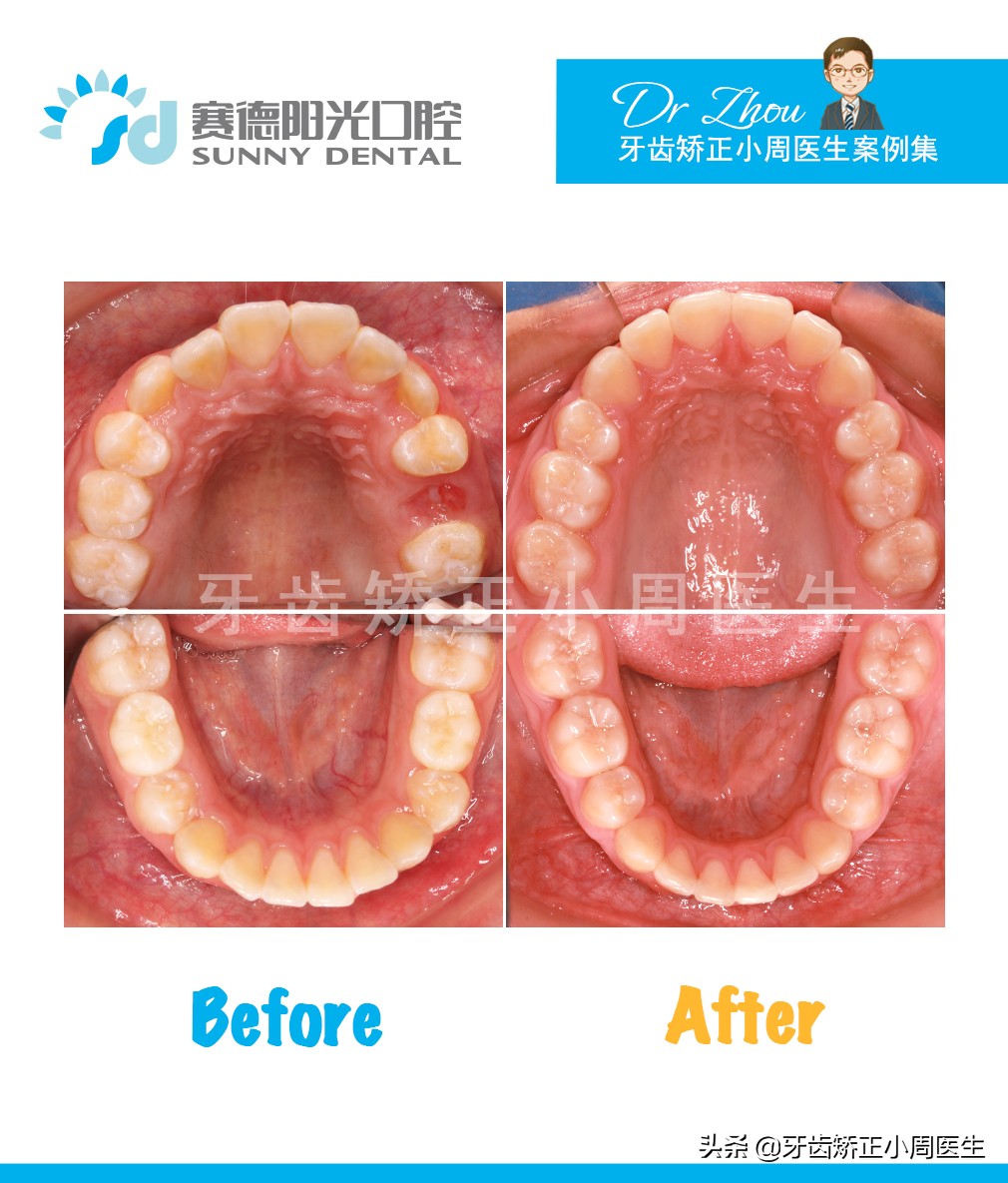 下巴后缩整容玻尿酸还是假体,如何不靠整容改变下巴