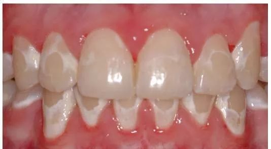 超详细的初戴正畸牙套的注意事项,戴全瓷牙套后需要注意什么