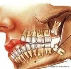 普及一下拔智齿全过程,拔智齿预警看完你再决定要不要拔