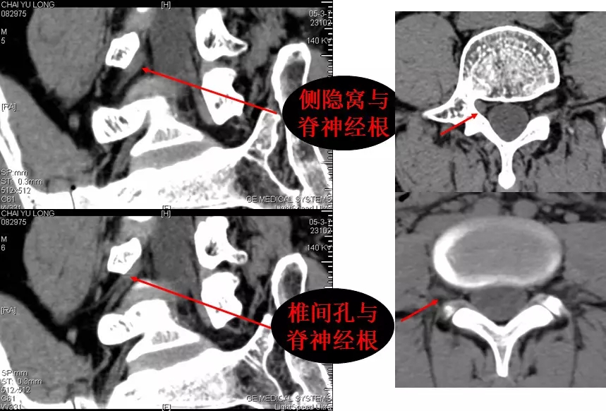 颈椎腰椎疾病ct及mri诊断,腰椎ct可以发现肠部病变吗