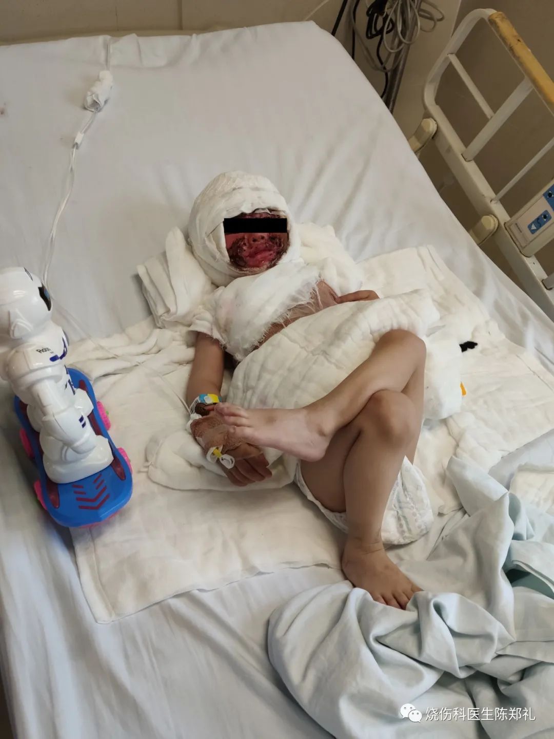 疤痕疙瘩怎么治疗最好最快,疤痕疙瘩中药治疗成功案例