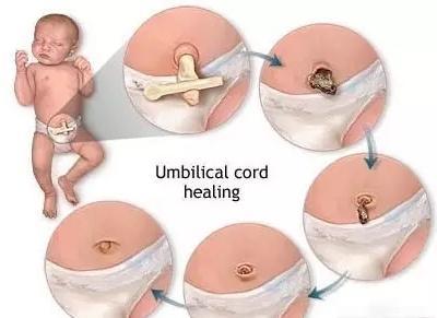 宝宝肚脐突然渗血多怎么回事,新生儿脐带脱落后肚脐出血的护理