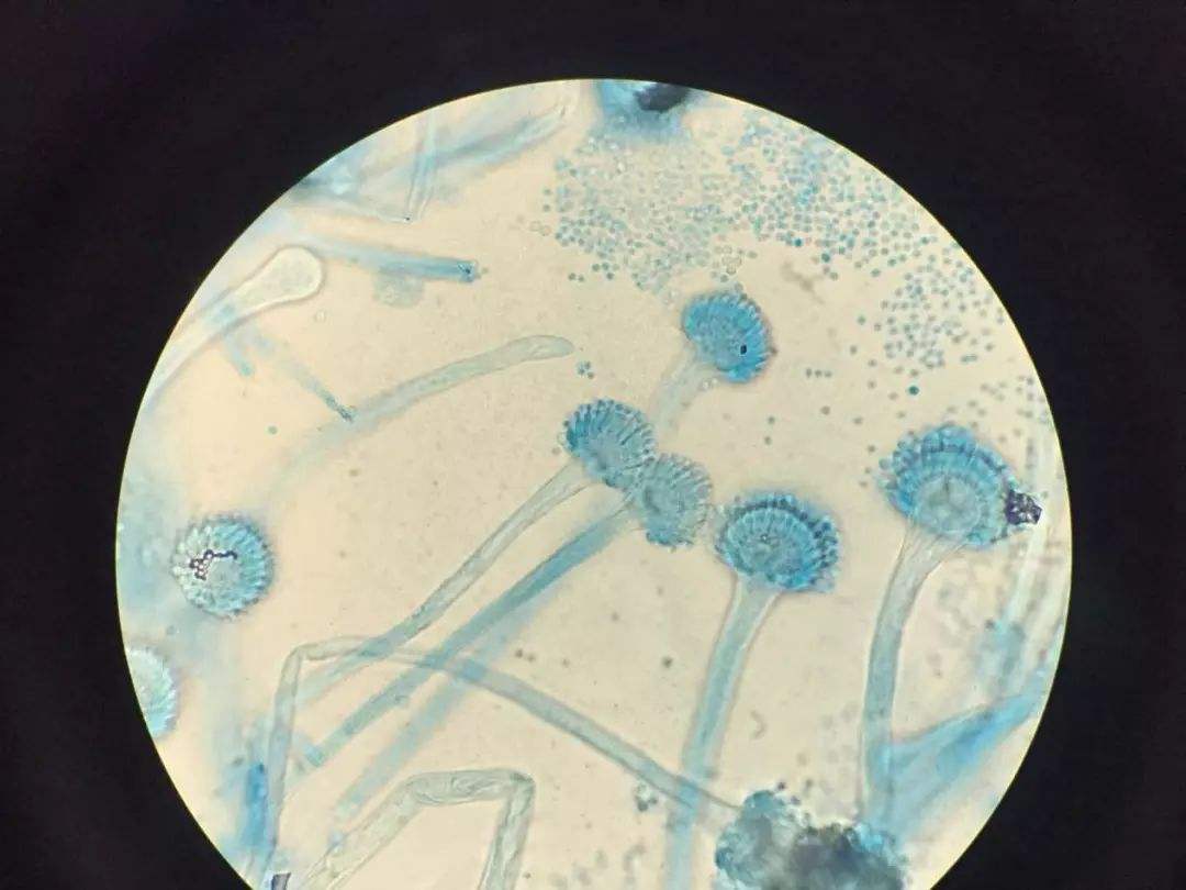 肺曲霉菌病和曲霉菌肺炎是一样吗,曲霉菌性肺炎怎么治