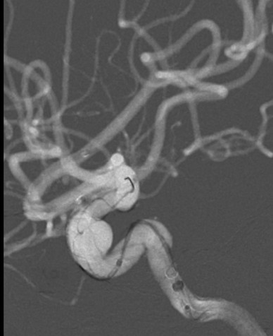 Tubridge®治疗多发性动脉瘤