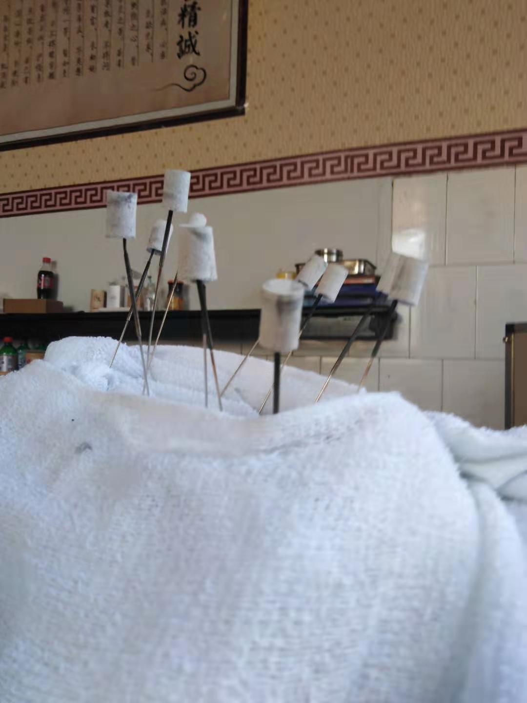 小诊所针灸出现医疗事故怎么处理,扎针灸医疗事故