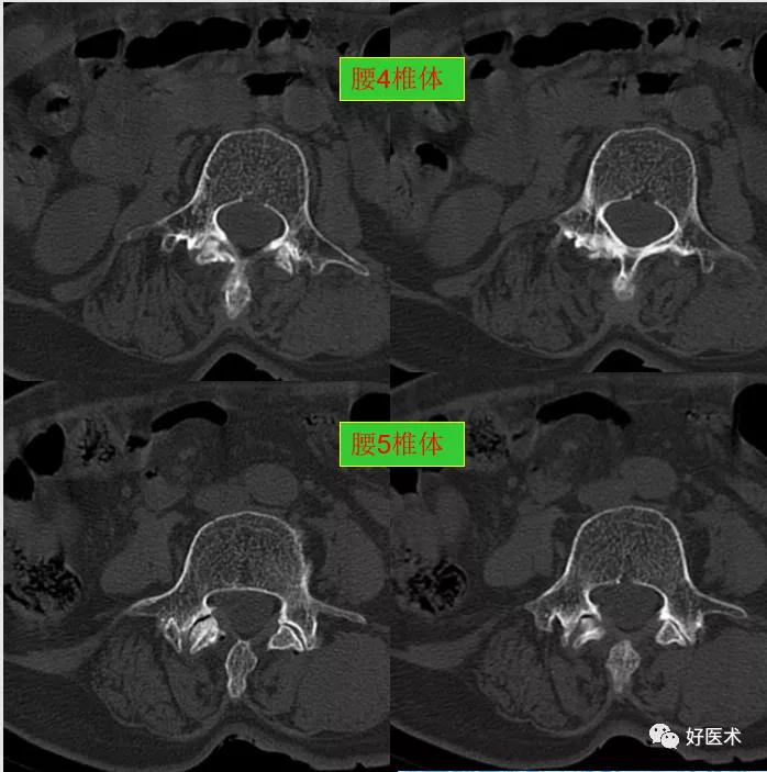 腰部ct需要注意事项,做腰部ct需要注意的事项
