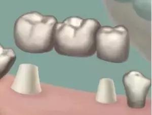 武汉29岁女子整牙掉一半,女人35六岁就开始掉牙了