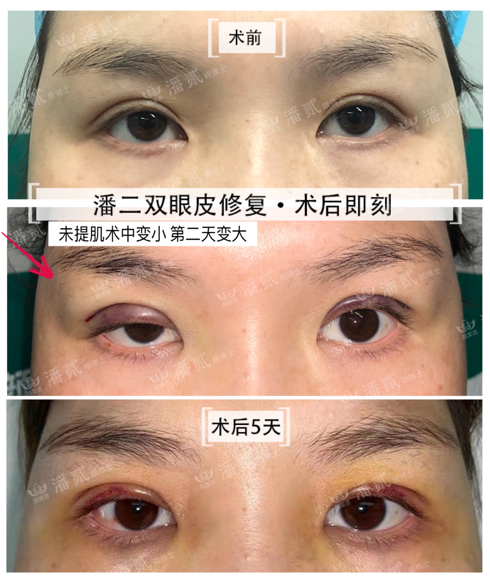 10年前做过韩式双眼皮,做过韩式三点双眼皮还能开眼角吗