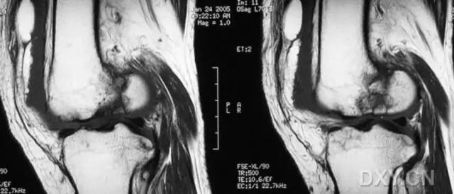 几种严重骨折医学名称,常见的骨折有哪些名称