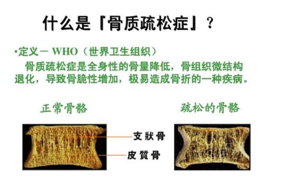 “骨头老了”怎么办?要补钙吗?医生说:有些需要补,有些不需要