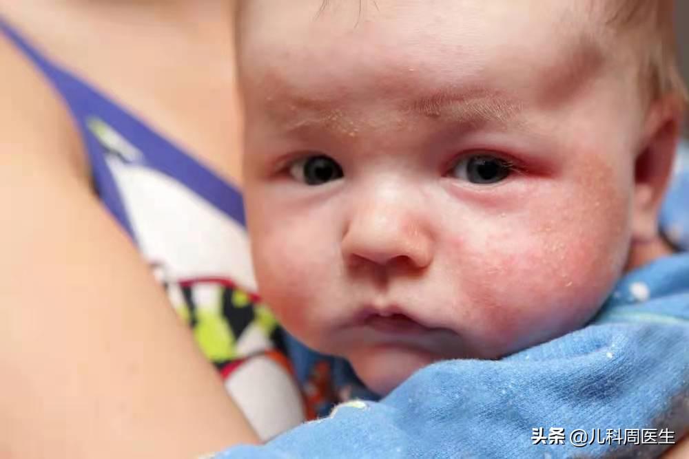 宝宝长痱子淹脖子怎么办,痱子和湿疹的预防和护理