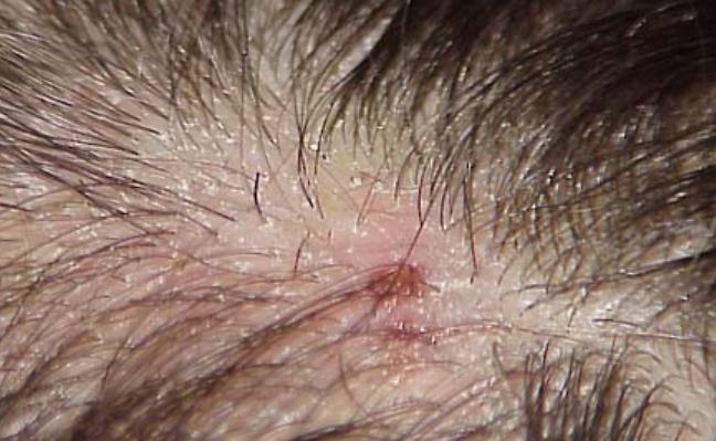 头皮上凸起一个硬疙瘩抠了又长,头皮长疙瘩抠了反复结痂怎么治