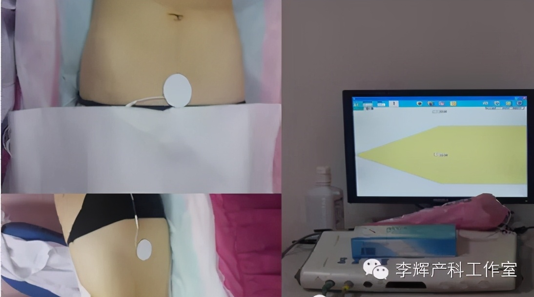 顺产后42天复查建议盆底康复治疗,产后42天复查医生要求做盆底康复