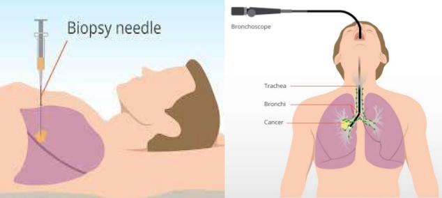 发现肺癌早期要不要做基因检测,磨玻璃型早期肺癌用做基因检测吗