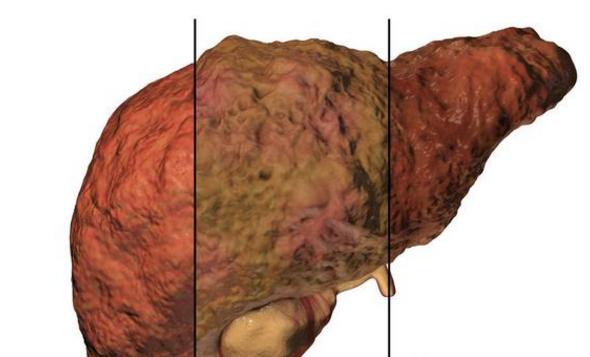 肝脏变黑的三个地方图,肝变硬前预兆