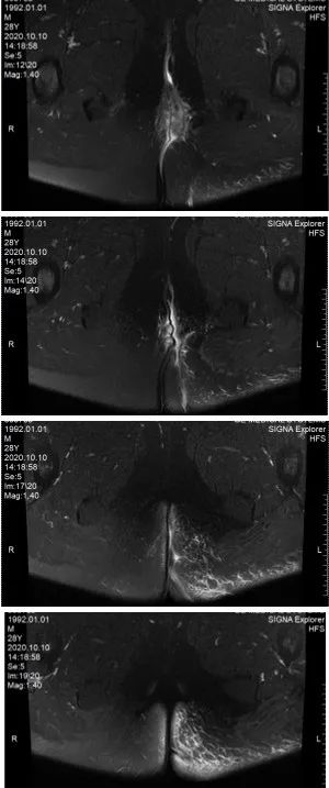 外阴坏死性筋膜炎,坏死性筋膜炎基础研究