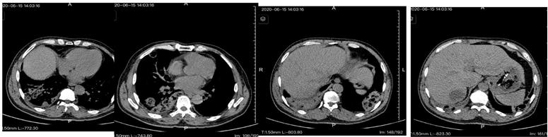 主任医师查房：这个“肺空洞”不简单
