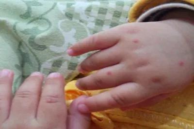 宝宝溃疡是缺什么吗,一岁半宝宝上火嘴里溃疡怎么办