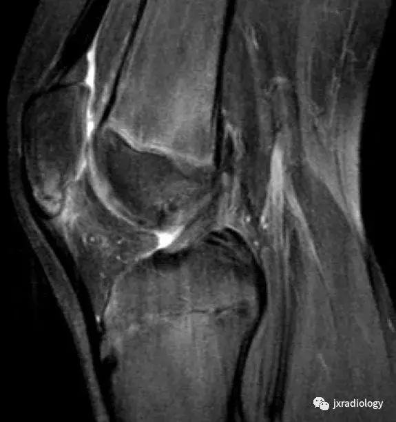 磁共振天天诊断骨髓水肿，但您知道原因吗？