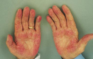 有肝掌蜘蛛痣得肝硬化的几率大吗,有肝掌和蜘蛛痣一定是肝硬化么