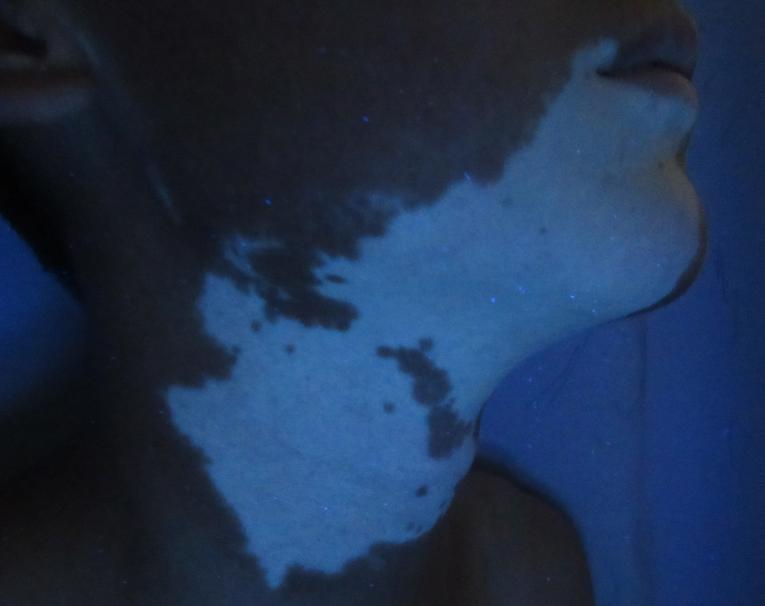 幼儿白癜风分几种类型啊,白癜风都有什么类型