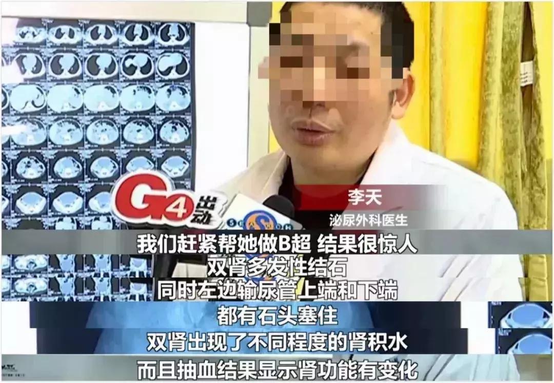 1岁孩子双肾长满结石,五个月婴儿双肾长满结石