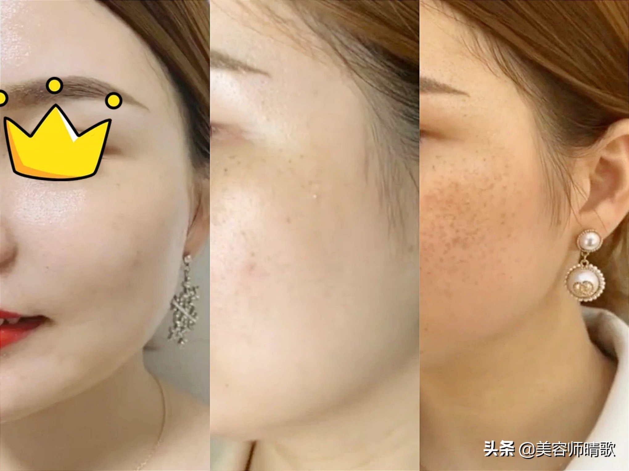 长斑应该注意的饮食事项,长斑的过程你了解了吗