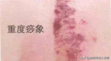 刮痧后出的痧怎样消退得快,刮痧后表现出来的痧有哪几种