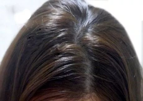 头发易出油头皮多怎么回事,头皮上有螨虫头发掉怎么办