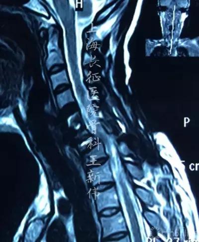 颈椎外伤受损如何治疗,颈椎损伤手术恢复怎么样