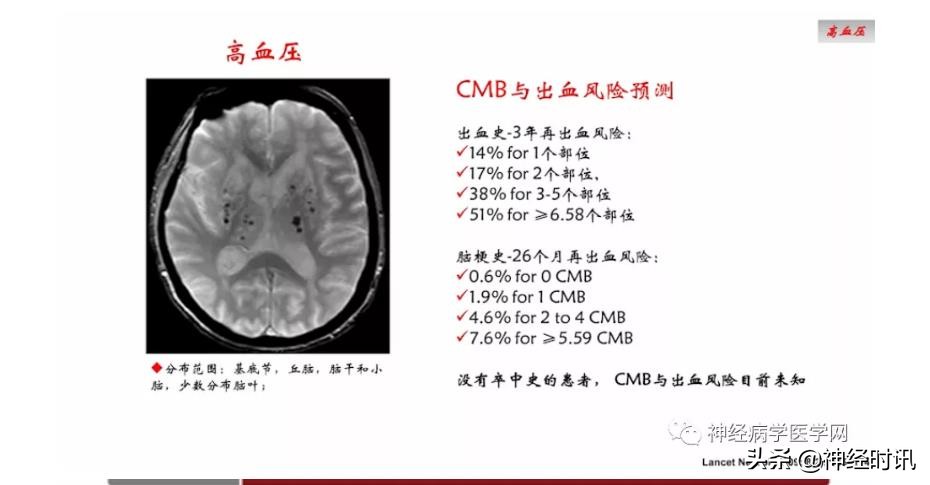 缺血性脑血管病出血评估,脑血管微出血怎么治疗