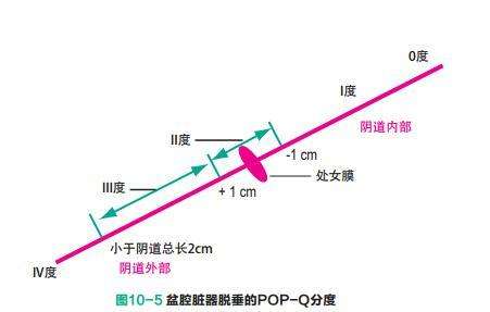 ella产后尿失禁原因,ella生二胎的后遗症