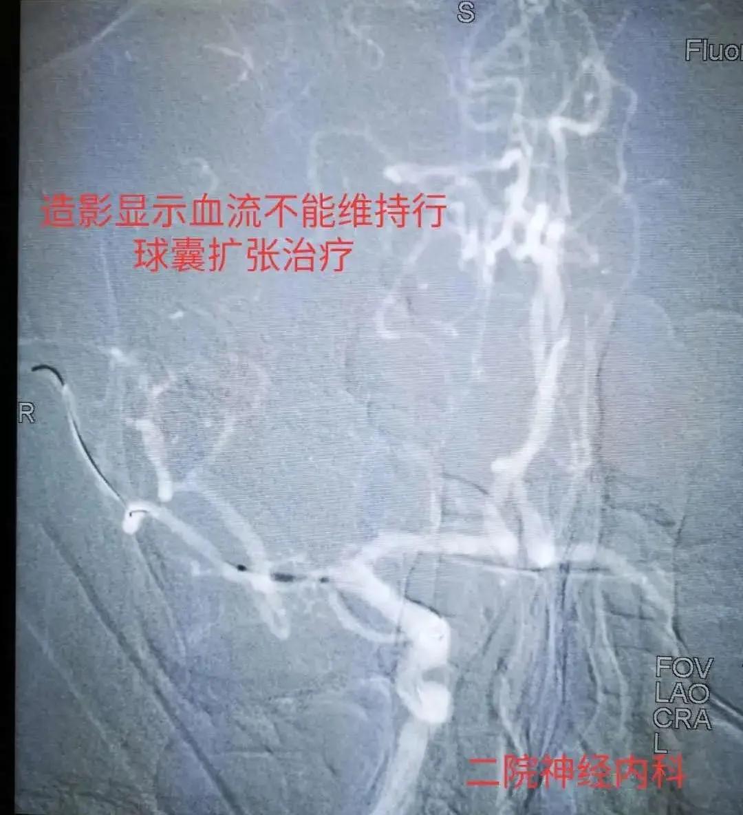 经皮颅内动脉取栓术全过程,为患者打开生命希望之门