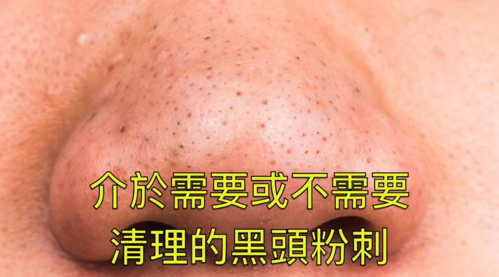掏耳屎挤黑头粉刺清理毛孔有用吗,黑头粉刺到底要不要挤出来