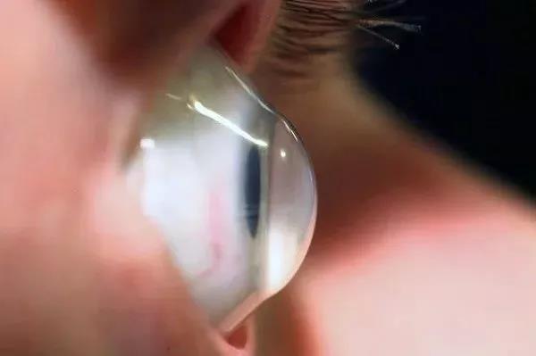 第一个做激光近视的人怎么样了,激光近视经历