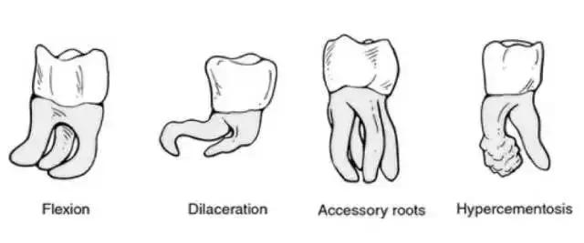 拔两颗智齿花了1800,一次性拔2颗下智齿