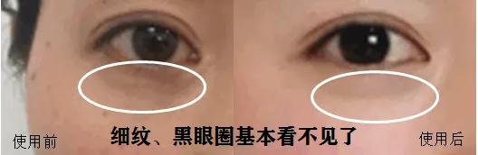 去眼纹去黑眼圈用什么方法,去眼袋黑公认最好用的土方法