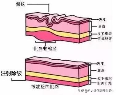 才20岁脸上有皱纹咋回事,才20岁就有皱纹了怎么办