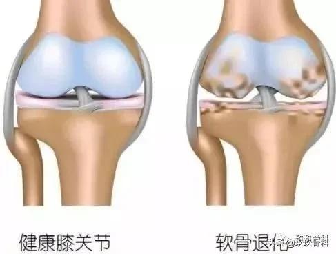 氨糖类骨关节药,氨糖骨关节