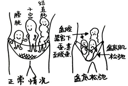 漏尿，中老年女性的难言之隐！