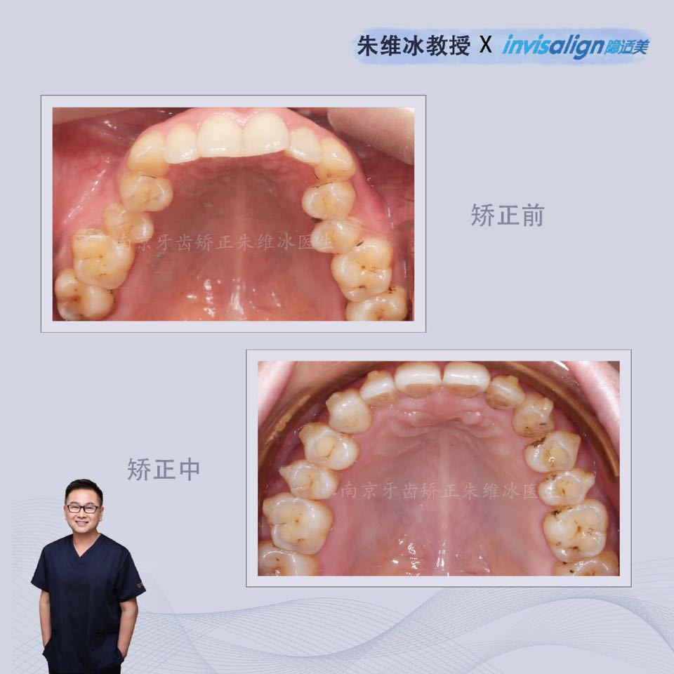 隐适美牙齿拥挤矫正真实案例,南京朱维冰